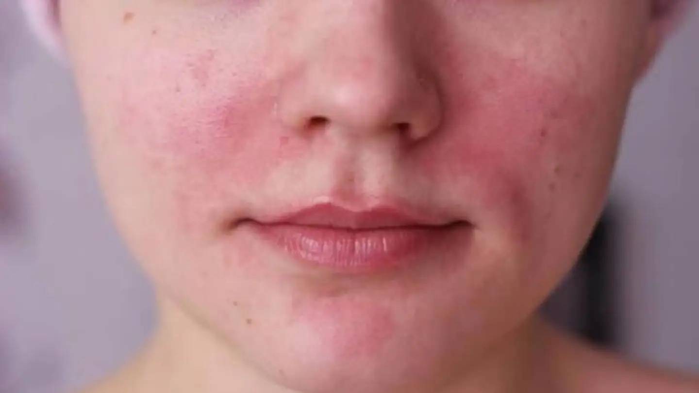 造成面部泛红的主要原因除了皮肤薄等体质原因外,还有温差,酒精,香辛