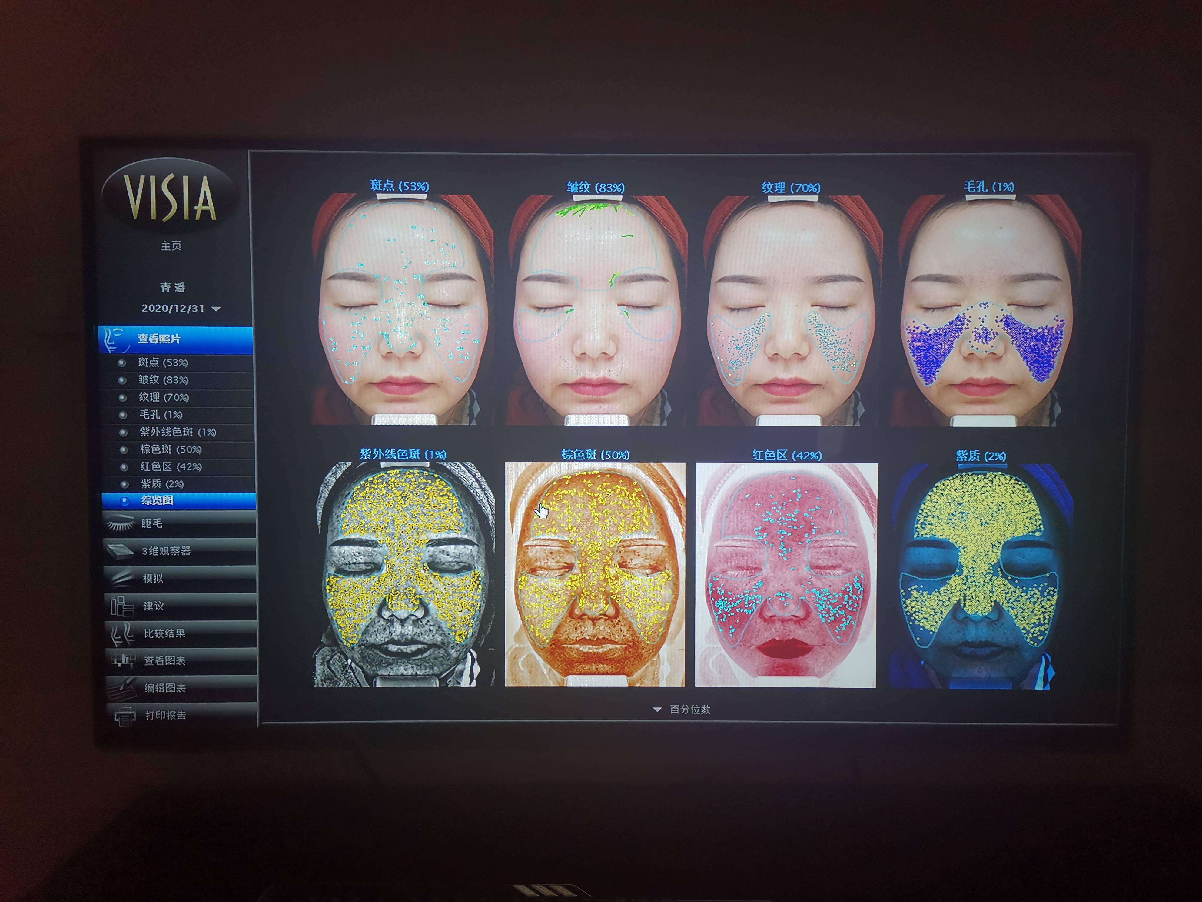 深度科普为什么一定要做visia皮肤检测