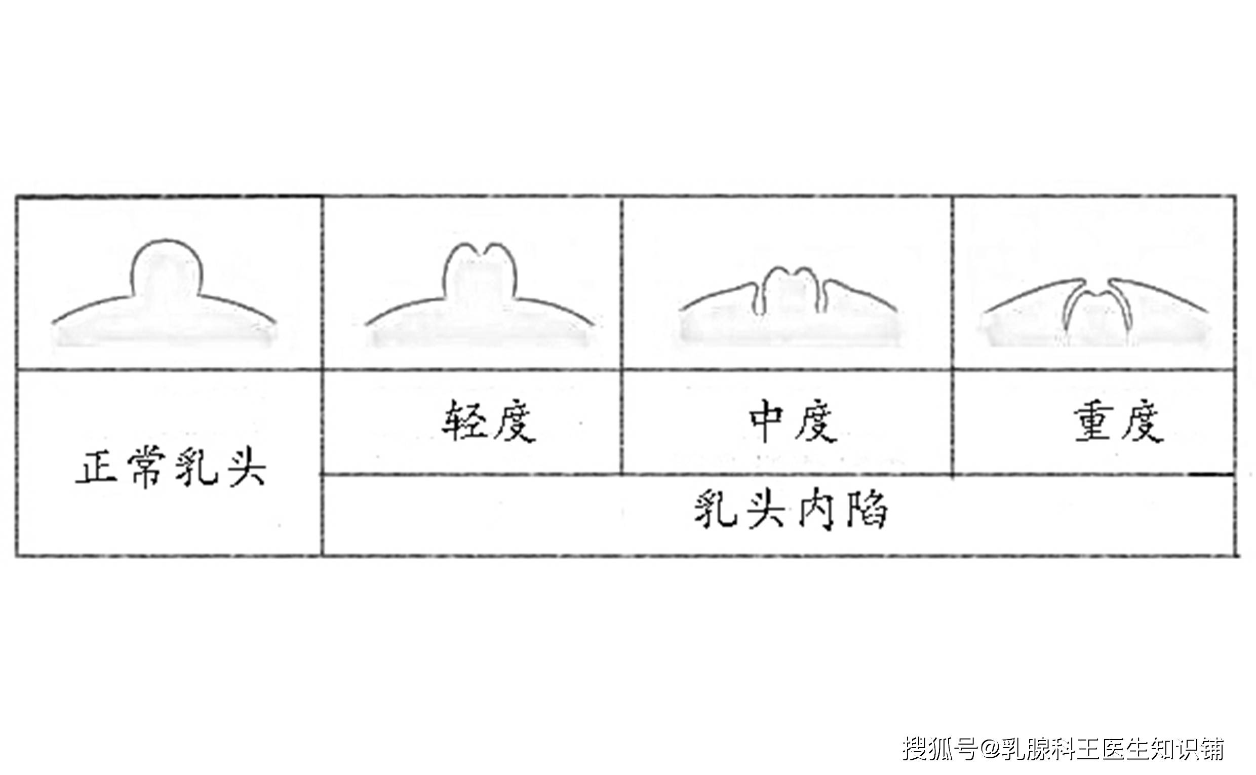 女性健康竟然不知道乳头内陷对身体危害这么大
