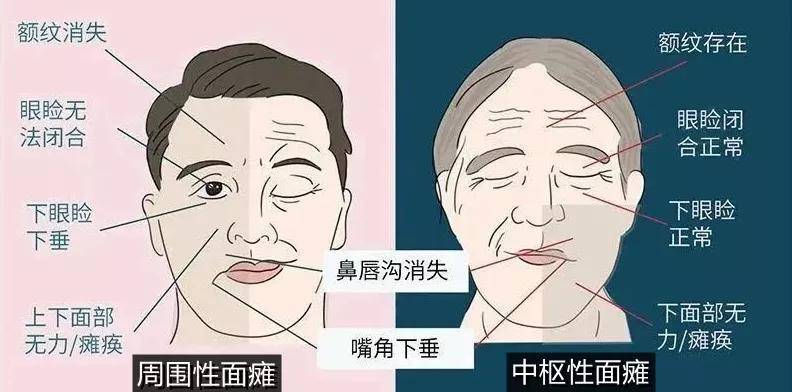 面肌痉挛早期辨别图片