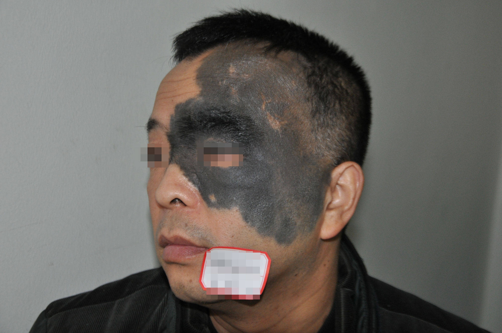 根据体检标准,面部,颈部长径超过1cm的血管痣,色素痣,胎痣等不合格