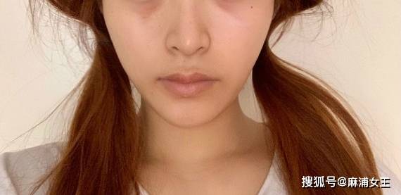 印第安纹剥离越早做越好吗印第安纹剥离有什么后遗症