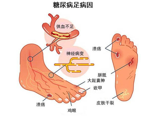 研究證實間充質幹細胞治療糖尿病足有益糖足的傷口完全閉合率達82