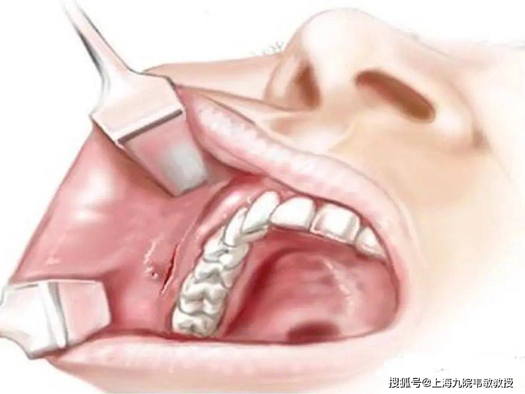 原創上海九院韋敏丨下頜角術後如何避免增生需要注意些什麼