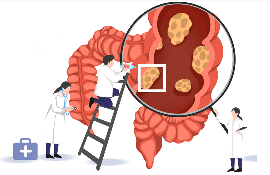 结直肠癌术后应该怎么做