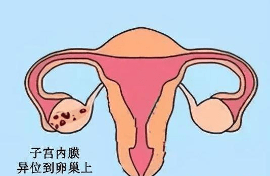 子宫内膜异位症图片