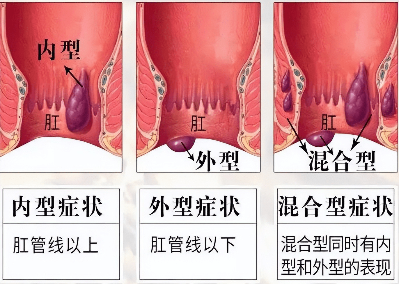 大便出血怎么办痔疮肉球该怎么消除痔疮问题全攻略