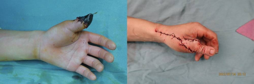 狐大医 | 乾坤大挪移！脚趾移植到手上，医生为27岁小伙再造“大拇指”