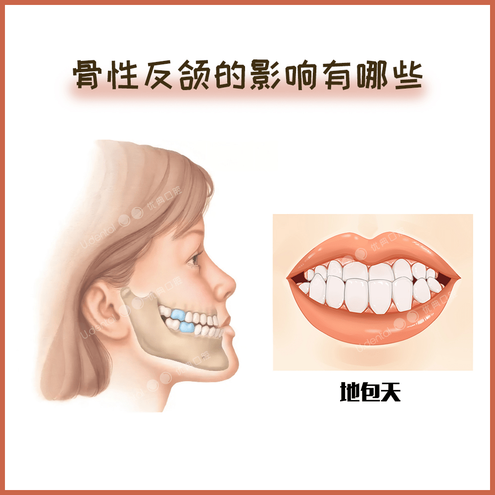 反颌是什么意思图片