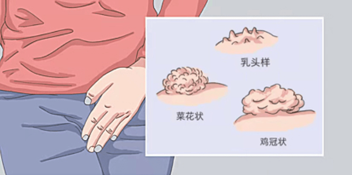 郑州合心医院:私处长了红肿疙瘩,是尖锐湿疣吗?