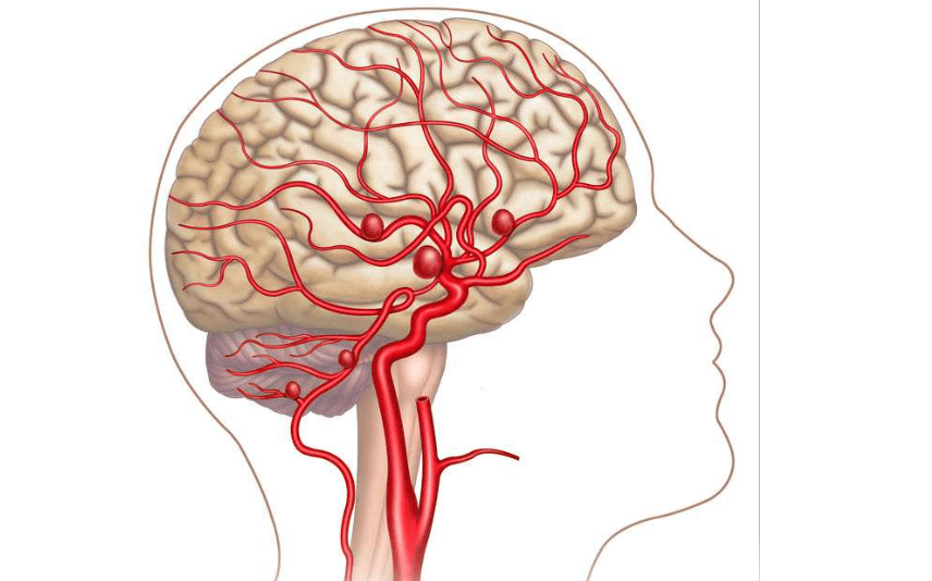 脑出血的物理治疗有用生理盐水擦腋窝,腹股沟等大动脉经过的部位来给