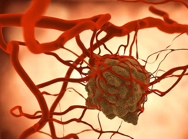 人体肿瘤不只是基因突变还有多个因素,而且肿瘤坏死也会引发癌细胞