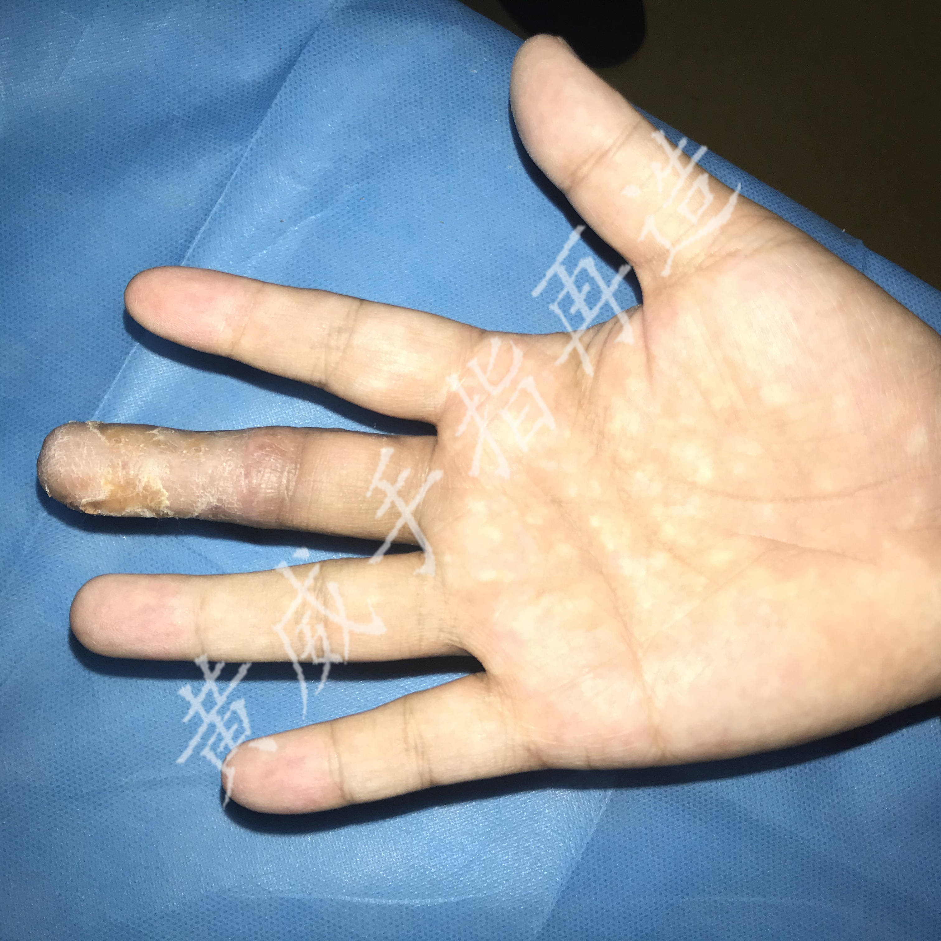 【手指再造专家黄威案例分享】母亲手指残缺,女儿存钱为其修复