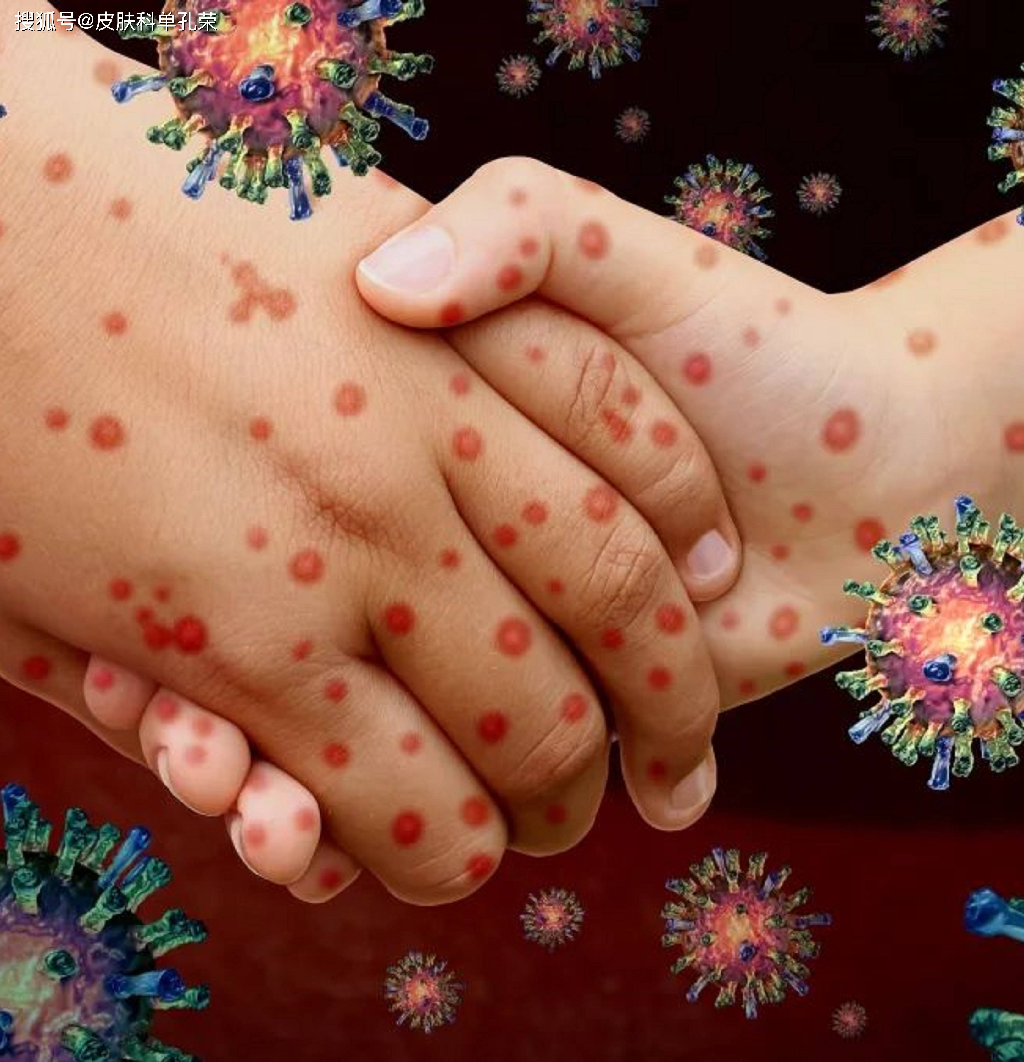 莫名其妙的长癣,竟是爱宠传染的皮肤病,皮肤科单孔