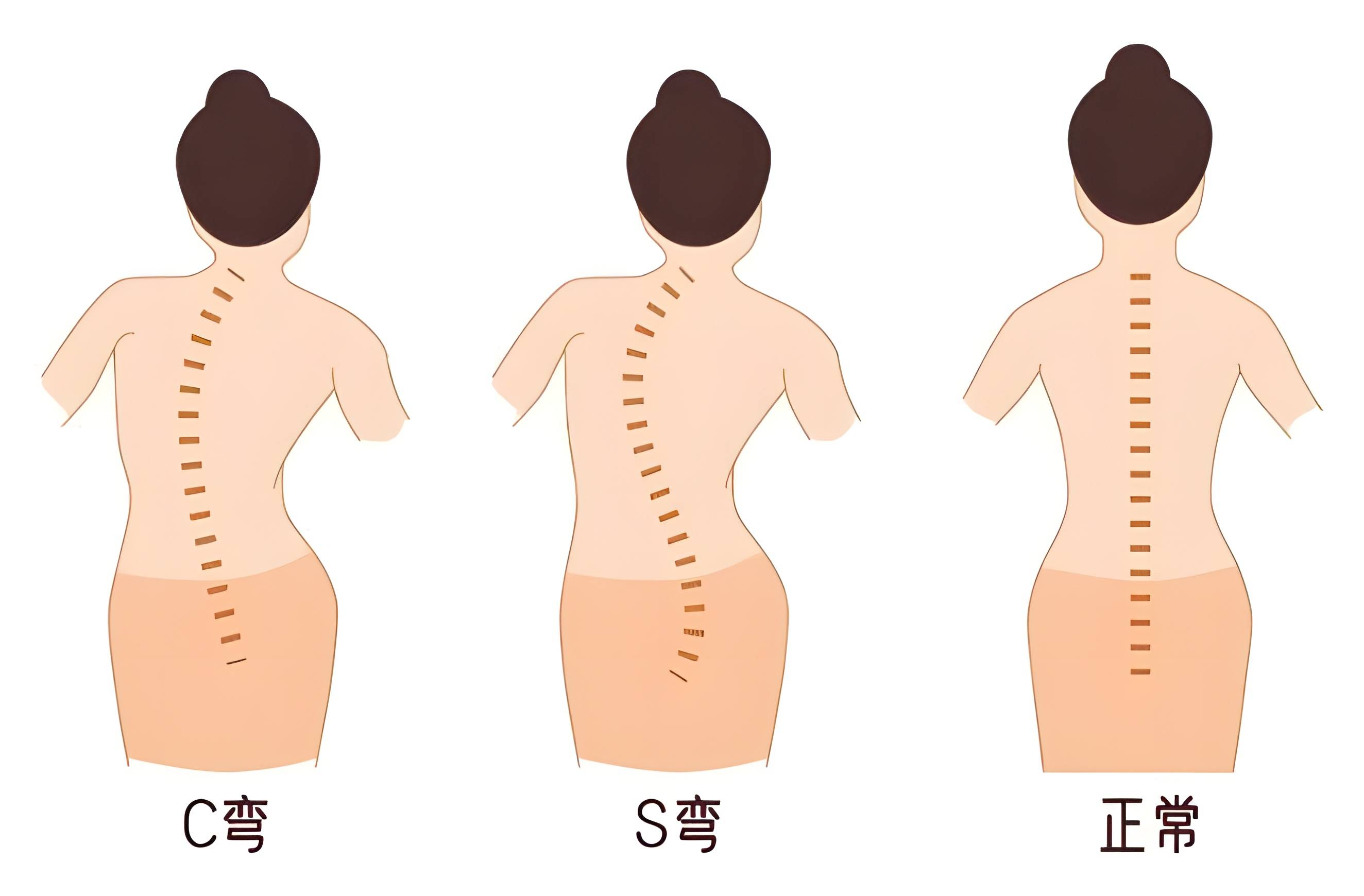 脊柱侧弯的卡通图片图片