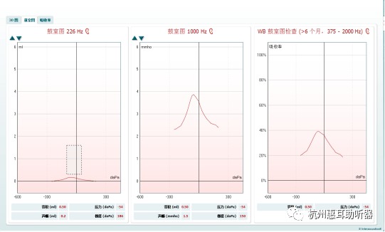 声导抗:双耳a型纯音听力:双耳58.