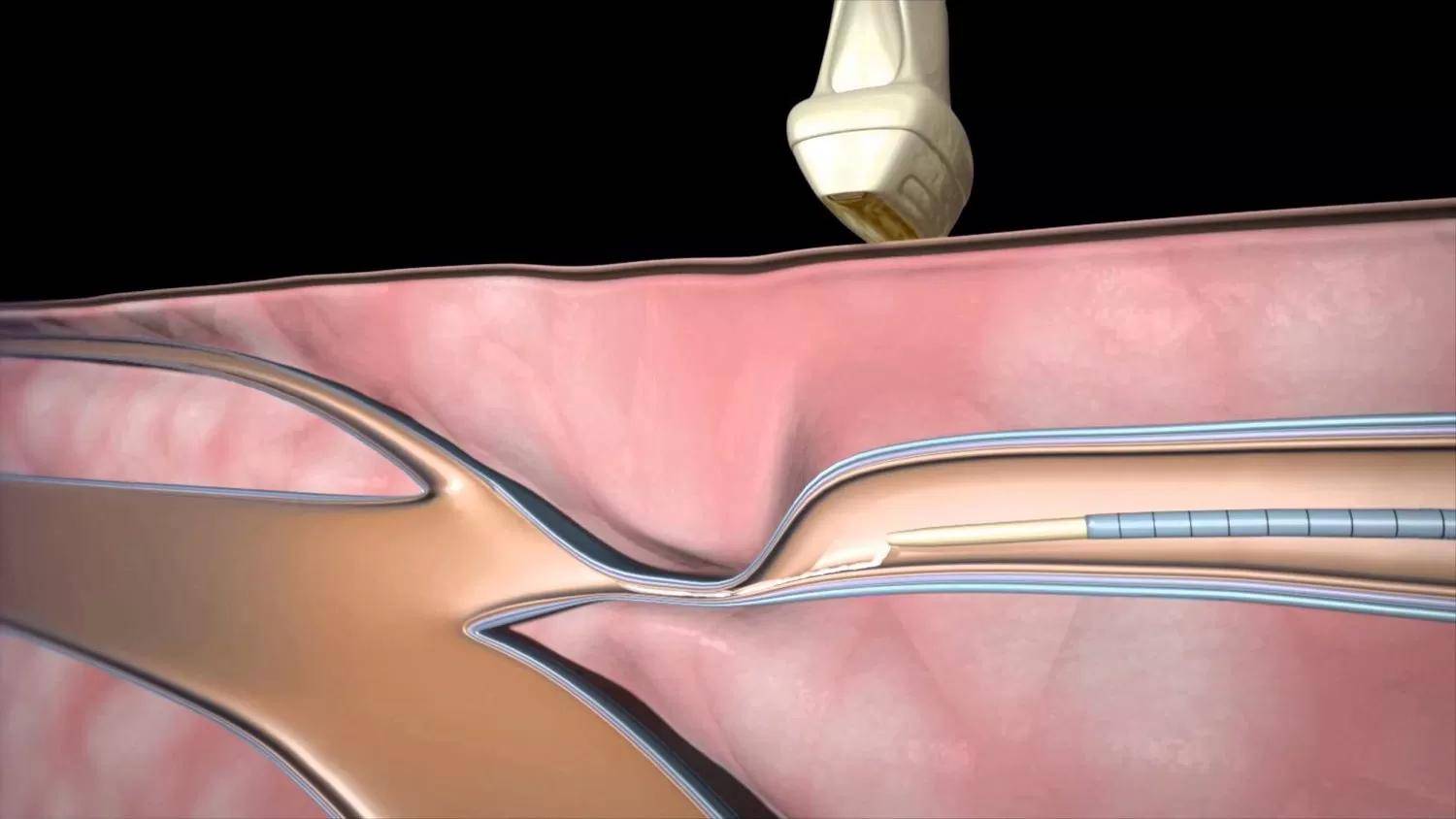 生物闭合胶治疗静脉曲张靠谱吗?