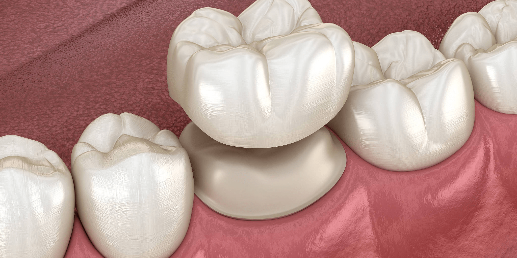 全瓷牙能用多久?你知道吗?