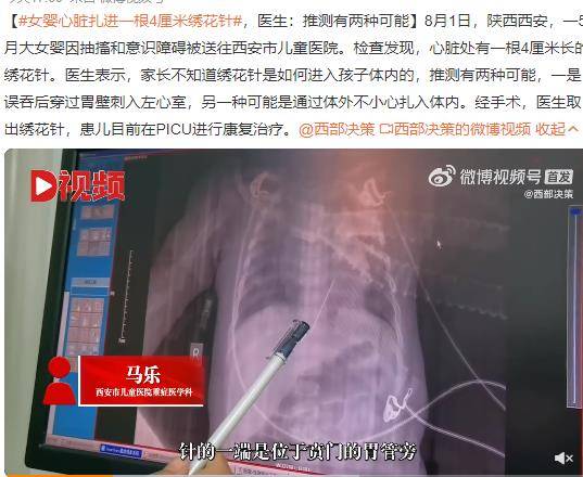 女婴心脏扎进一根4厘米绣花针 医生推测有两种可能