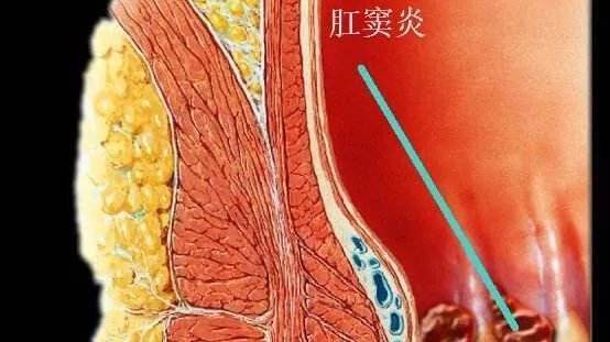 肛窦的位置肛窦炎图片图片