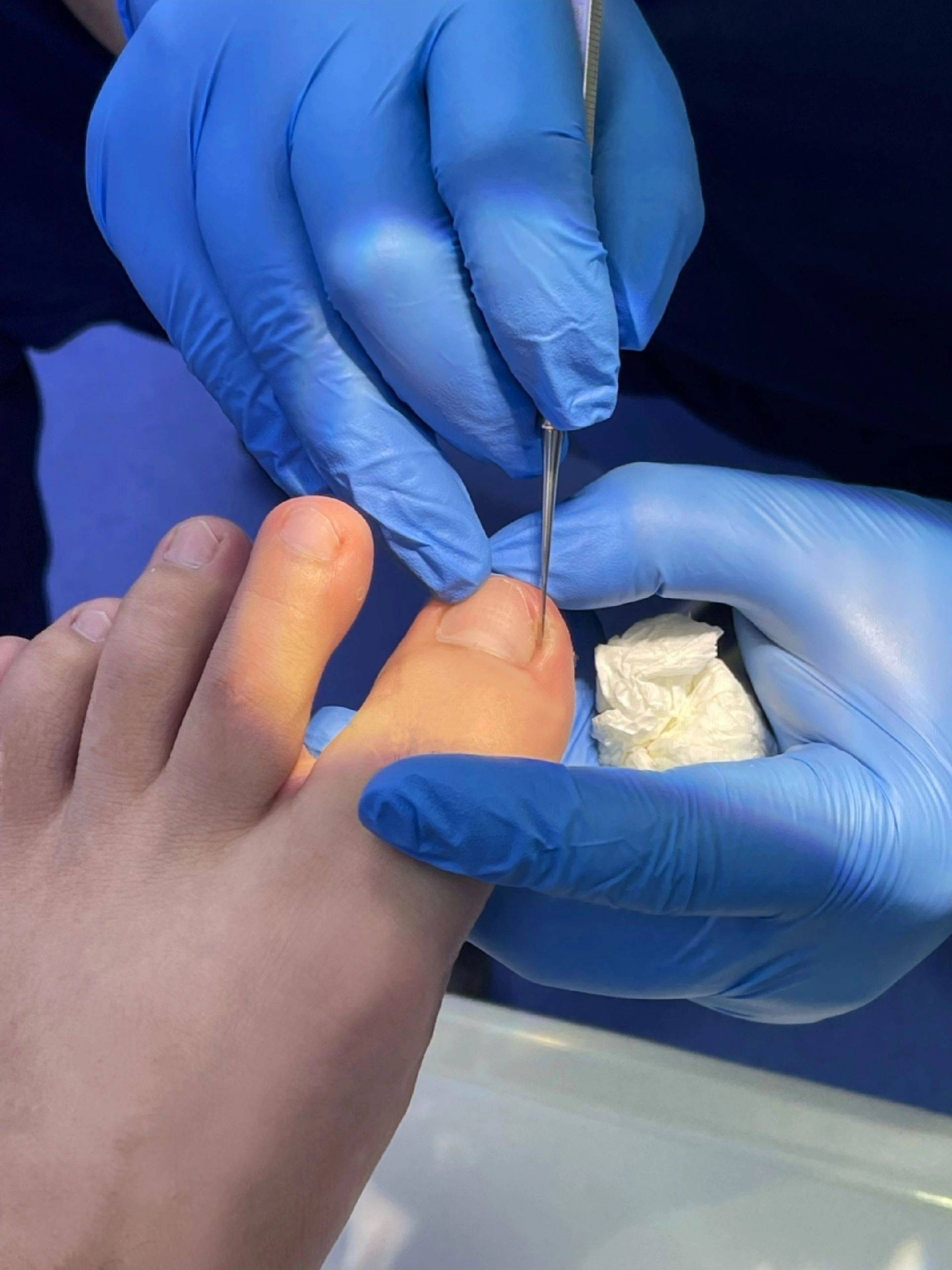 我自己之前的情况就是指甲颜色又黄又不透亮甲面分层还掉碎屑渣,用对