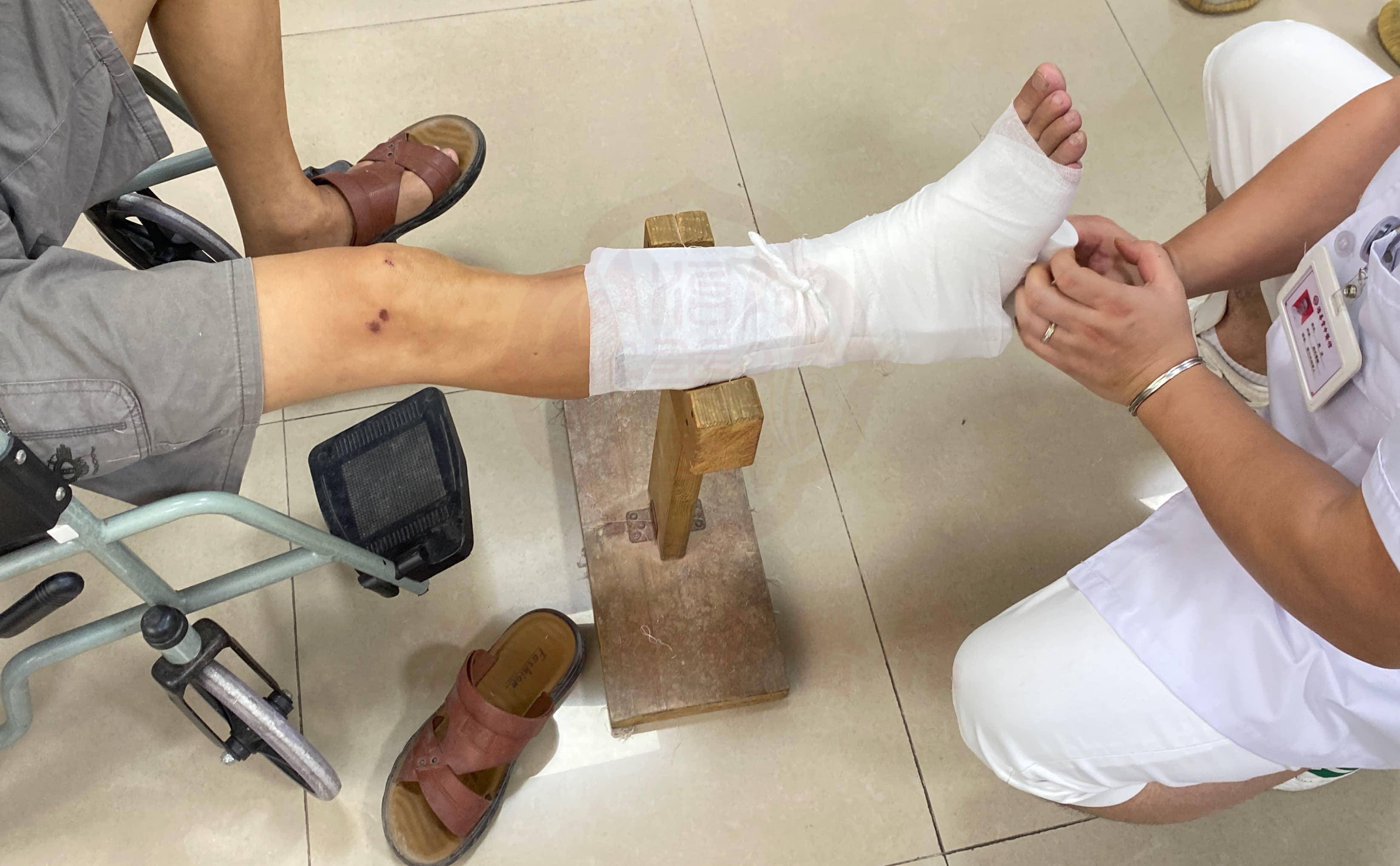 关于骨折复位后注意事项!_康复_医生_生活