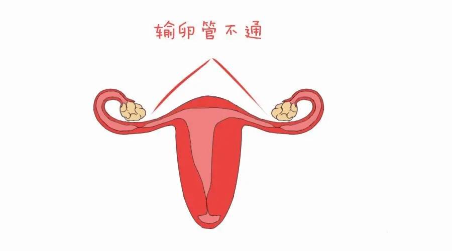 输卵管自测9种方法(输卵管堵塞对女性的危害和如何预防)