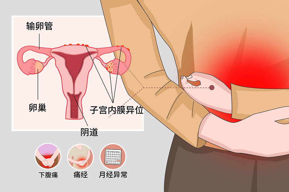 兰州天伦孕育科普时间 子宫内膜异位会影响怀孕?