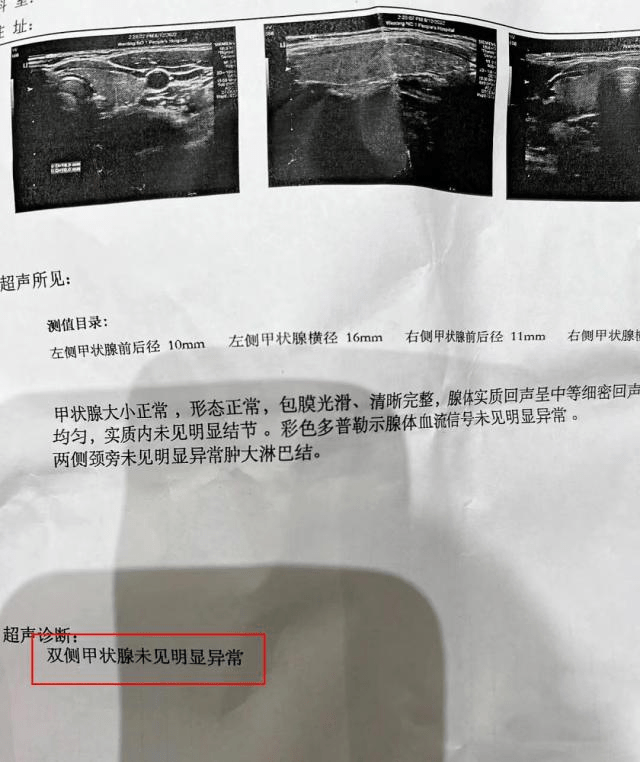 朝阳门中西医结合医院翟章锁主任助患者消散3年结节