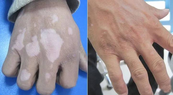 临沂24小时讯(张艳妮)白癜风中医又称"白癜","白驳风","白蚀"等,可