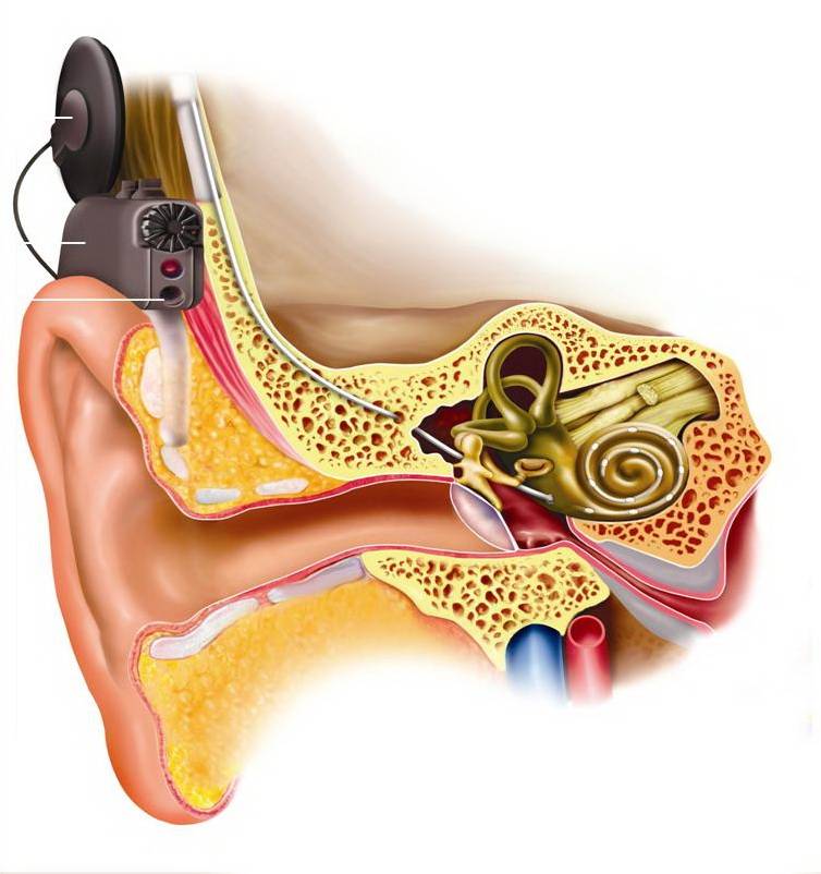 人工耳蜗寿命多长时间图片