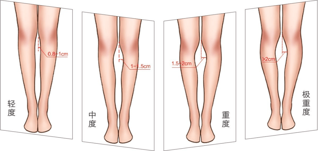 膝外翻胫骨内踝间距图图片