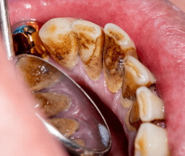 顽固牙渍刷刷就掉!过来人实测有效!