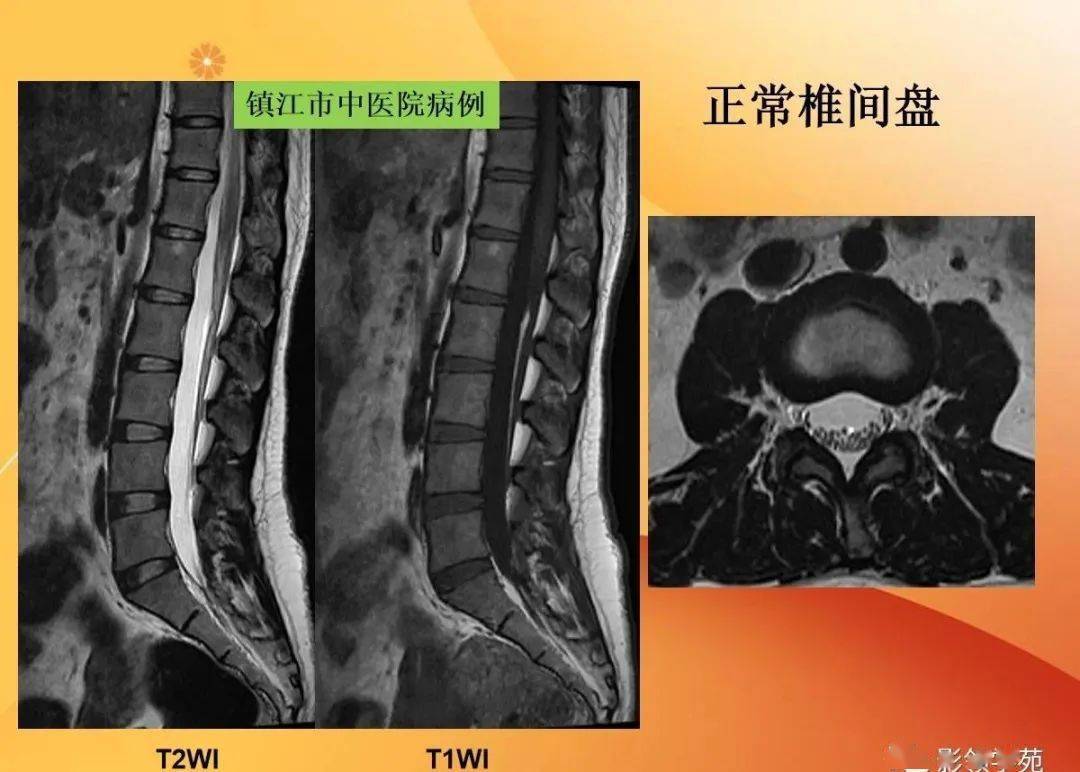 脊柱常见疾病的mri诊断