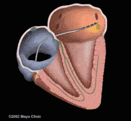 治疗因为房颤的危害非常大1形成血栓和栓塞发病的心房容易形成血栓