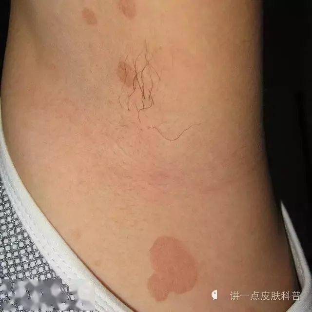 一到夏天前胸后背腋窝出现褐色圆形斑