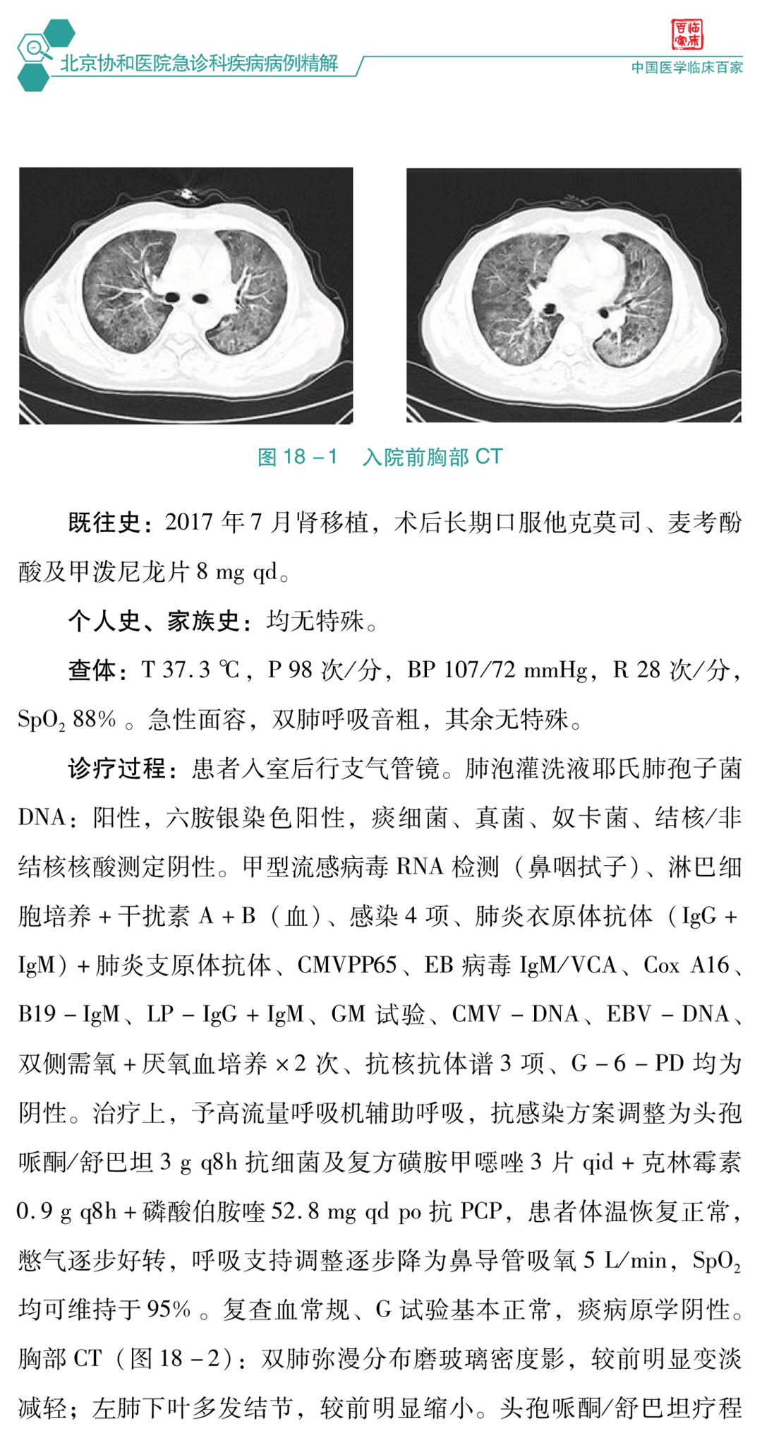 头痛001 病毒性脑膜脑炎1例002 肺炎链球菌脑膜炎合并脑脓肿1例003 单