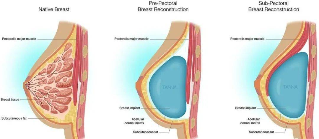 胸大肌前與胸大肌後乳房重建薈萃分析