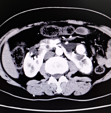 馬蹄腎合併峽部腫瘤一次手術成功解決三大問題