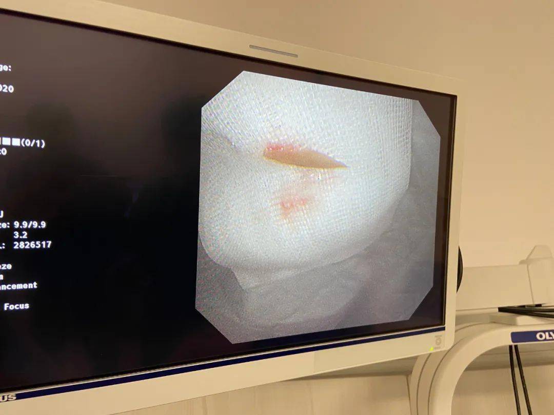 好惊险!鸡骨头卡在喉咙里,专家说江湖传闻的三种招式不靠谱