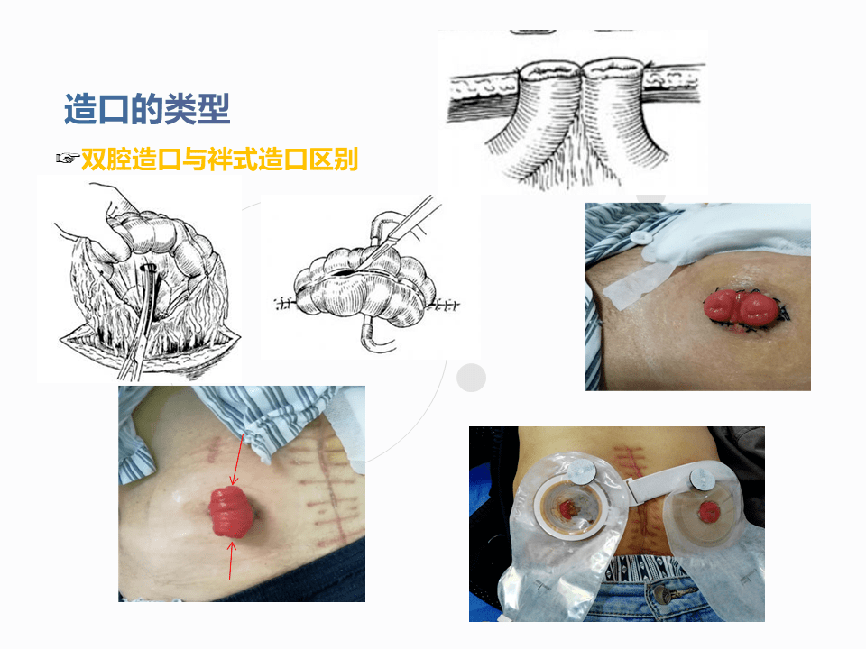 小肠造瘘手术图解图片