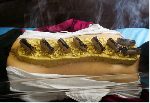 大源人民医院开设督脉铺灸—冬病夏治新选择,快来预约吧!