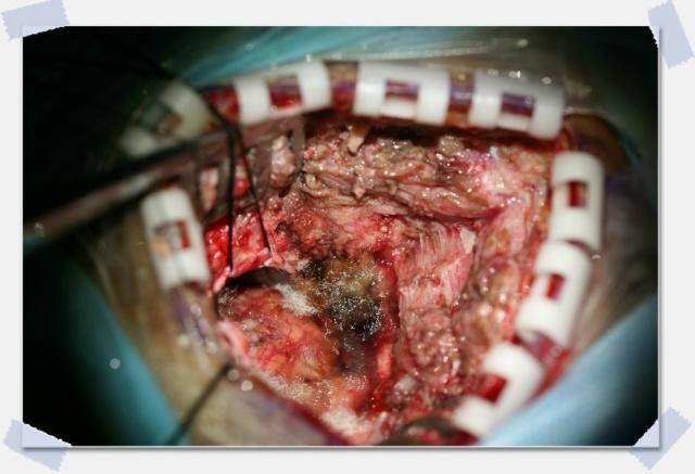 桥小脑角区胆脂瘤图片