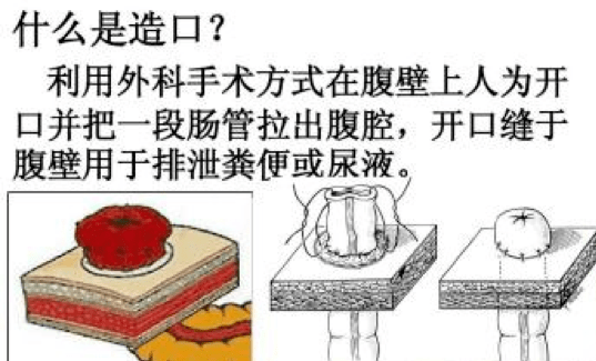 手术是分两步进行,第一次急诊手术先进行回肠双腔造口术,解决男童的