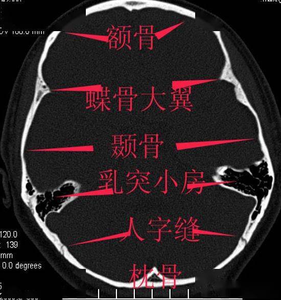 詳細標註的顱底解剖_手機搜狐網