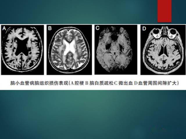 脑白质疏松 la 小动脉病变导致的白质纤维脱髓鞘;t2-fla