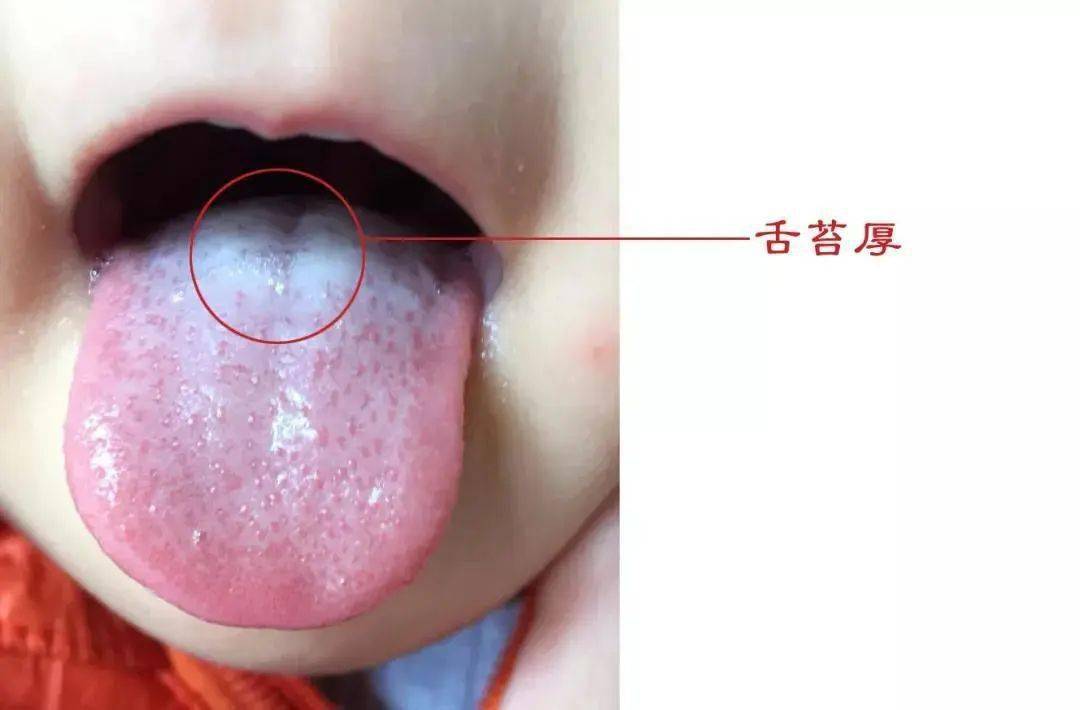 如果我们发现孩子舌质突然变红了,一般是体内有热;如果舌质变淡变白了