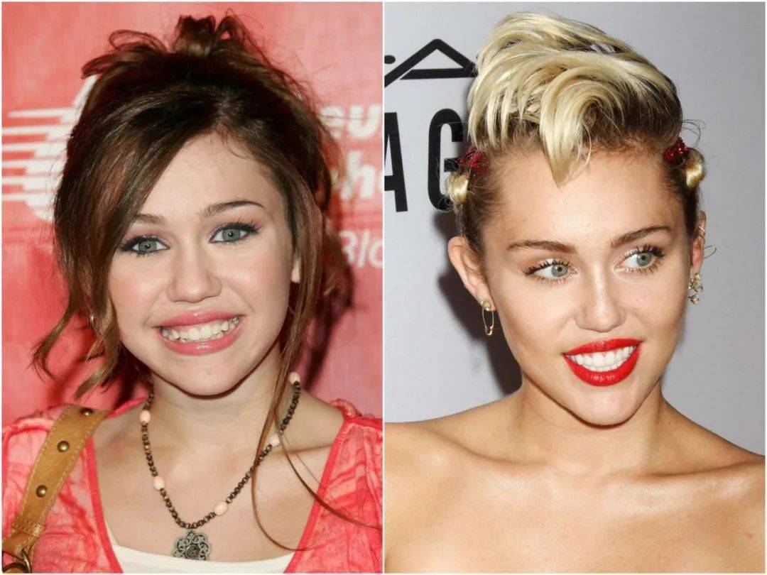 麦粒的牙齿本身就状况多多,2015年一口气拔了5颗牙齿,也是选择贴面.