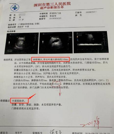 做完b超后,医生愣了:影像结果显示 中度脂肪肝,肝脏右叶最大斜径148