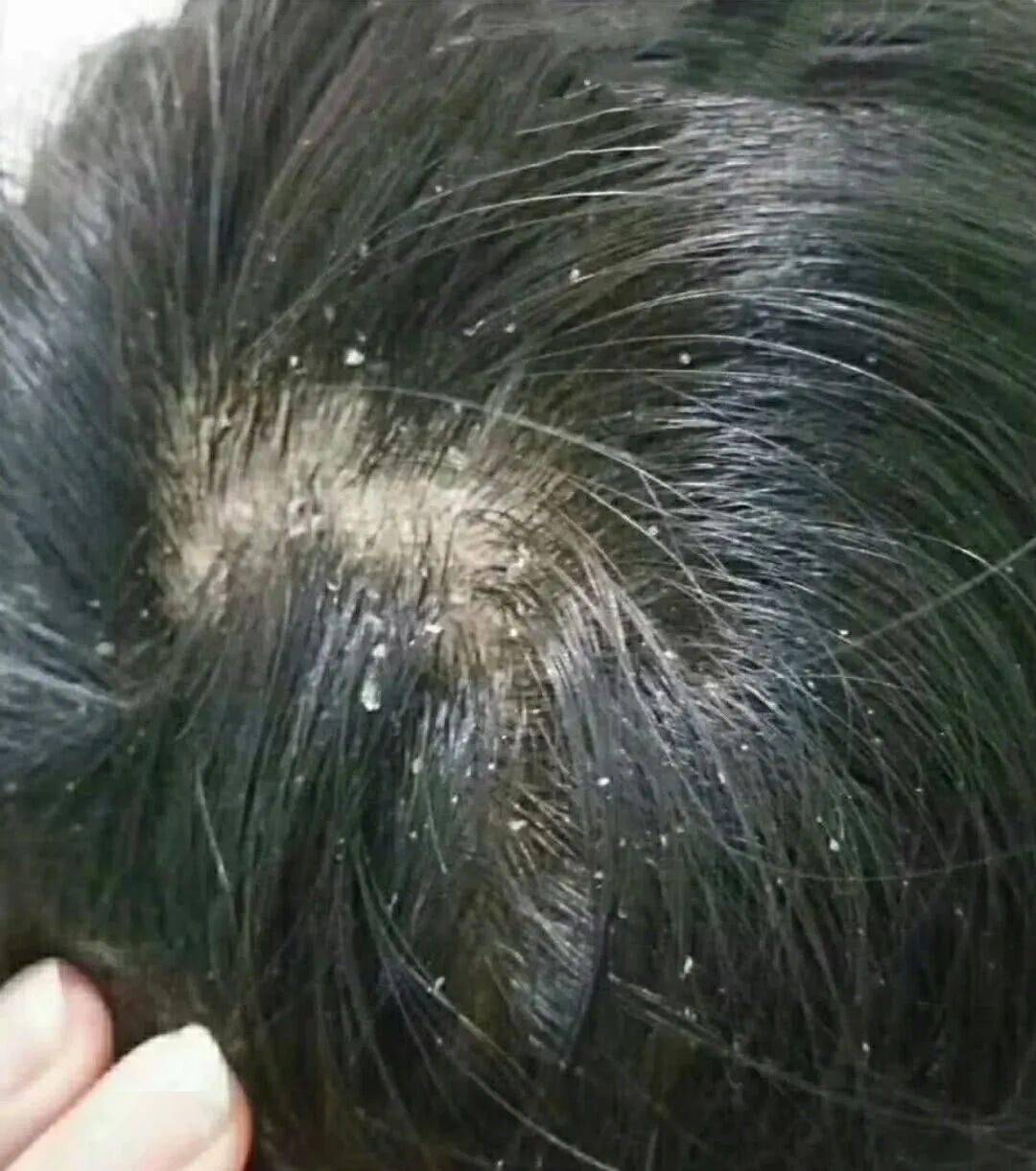 以下症状 头发隔天不洗就油得不行  经常性发如雪 都不敢穿黑色的衣服